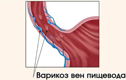 Варикозное расширение вен пищевода