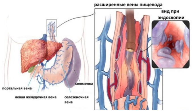 вид при эндоскопии расширенные вены пищевода