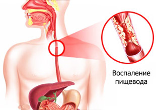 воспаление пищевода при рефлюксе