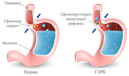 Нормальное пищеварение и развитие ГЭРБ