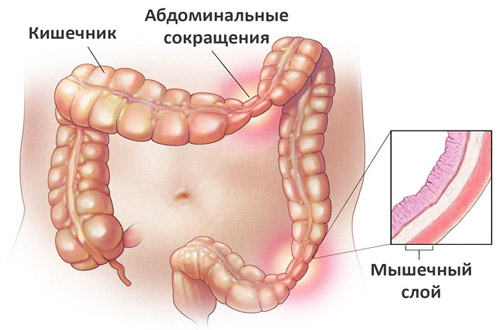 развитие синдрома раздраженного кишечника