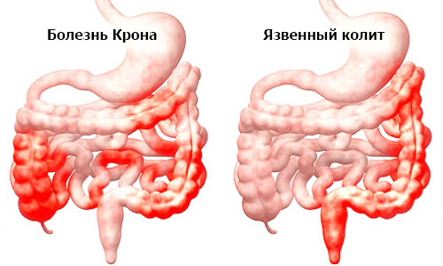 воспалительные поражения кишечника