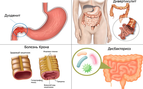 Разновидности болезней кишечника