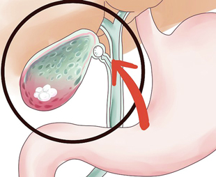 камни в желчном пузыре