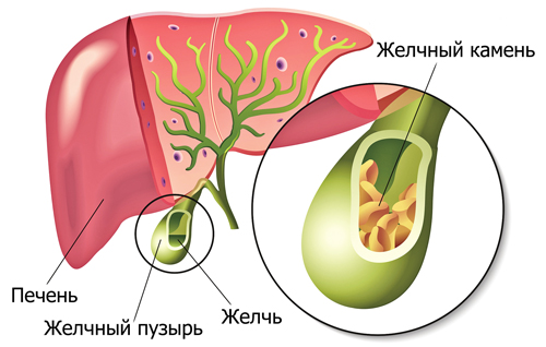 образование камней в желчном пузыре