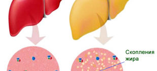здоровая печень и с жировым гепатозом