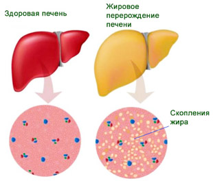 здоровая печень и с жировым гепатозом