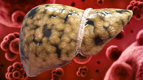 жировая болезнь печени с новообразованиями