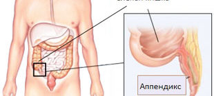 анатомическое расположение аппендицита
