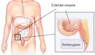 анатомическое расположение аппендицита