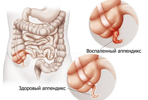 здоровый и воспаленный аппендикс