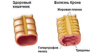 здоровый кишечник и пораженный болезнью Крона