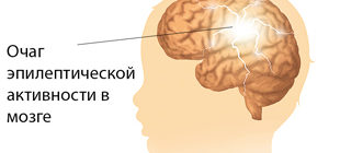 очаг эпилептической активности в мозге