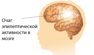 очаг эпилептической активности в мозге