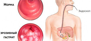 диагностическая эндоскопия эрозивного гастрита