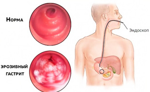 диагностическая эндоскопия эрозивного гастрита