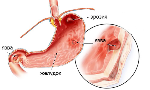 образование язв вследствие гастрита