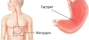 воспалительные патологии слизистой желудка