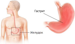 гастрит желудка