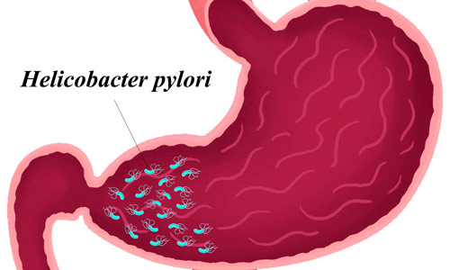 бактерии Хеликобактер как причина гастрита