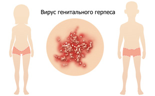 проявление вируса генитального герпеса у людей обоих полов