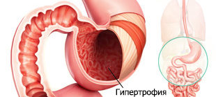 Гипертрофия слизистой желудка при гастрите