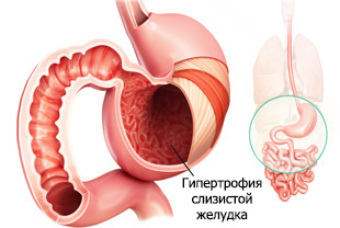 Гипертрофия слизистой желудка при гастрите