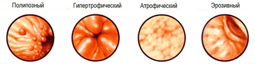 разновидности деформации слизистой желудка