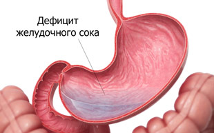 Недостаток желудочного сока причина гипоацидного гастрита