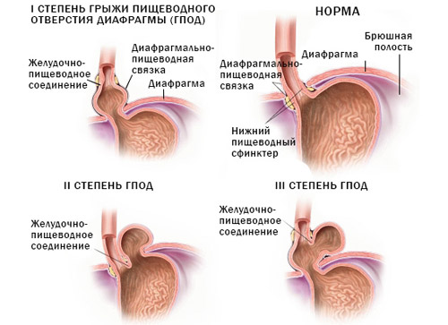 степени сложности грыжи