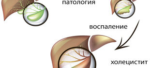 воспаление желчного пузыря