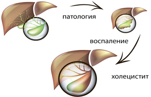 воспаление желчного пузыря