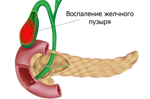 воспаление желчного при холецистите 