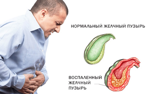 здоровый и воспаленный желчный пузырь