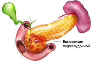 хроническое воспаление поджелудочной железы
