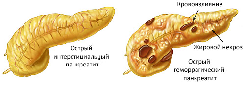 разновидность острого панкреатита