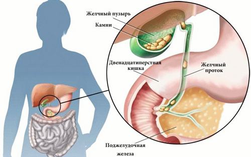 образование и выход камней в желчном