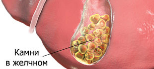 камни в желчном пузыре человека