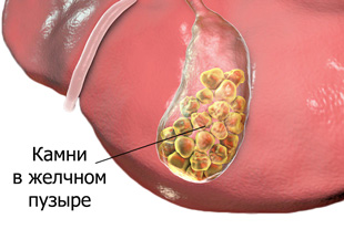 камни в желчном пузыре человека