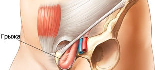 паховая грыжа внизу живота