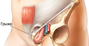 паховая грыжа внизу живота