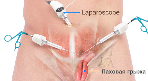 лапароскопическая операция на грыже