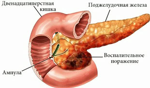 Панкреатит - воспаление поджелудочной железы