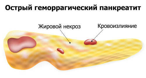 острый геморрагический панкреатит