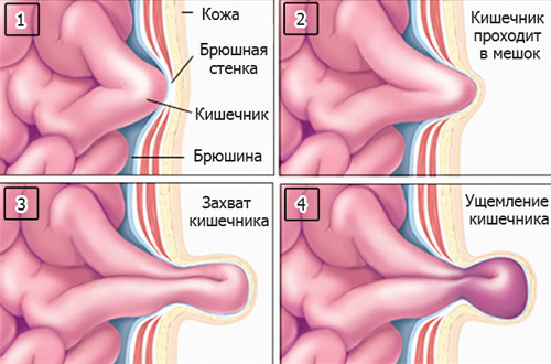 стадии образования грыжи