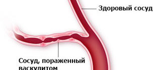 здоровый сосуд и пораженный васкулитом