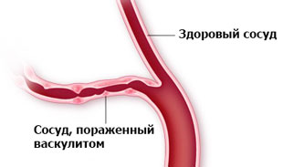 здоровый сосуд и пораженный васкулитом