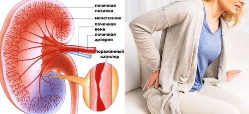 поражение кровеносных сосудов почек и боли