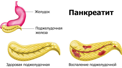 воспаление тканей поджелудочной железы