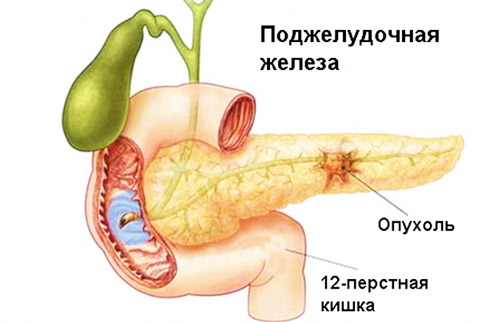 опухоль поджелудочной в результате осложнений при панкреатите